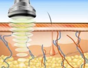 How does RF-lipolysis work